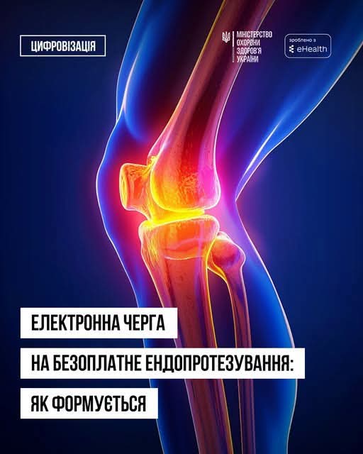Безоплатне ендопротезування: як потрапити в електронну чергу та де можна пройти операцію на Вінниччині